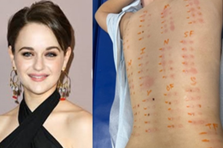 Joey King shares results of allergy test, says she's pretty much allergic to everything