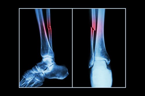 New machine algorithm can identify heart, fracture risks with routine bone scans
