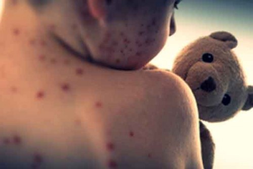 Measles alert in Sydney