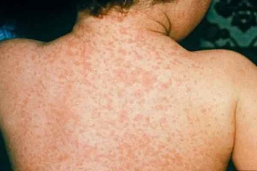 Measles outbreak in UP village, three children die