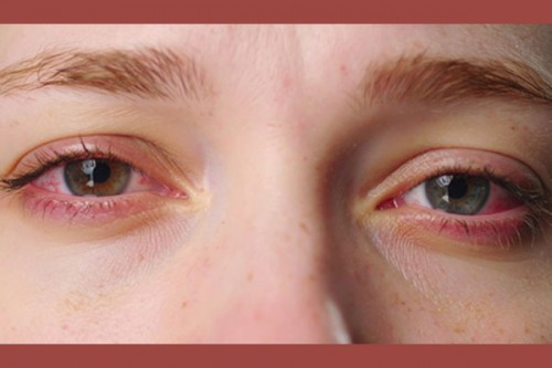 City doctors report 50 pc rise in eye problems as smog continues to engulf Delhi