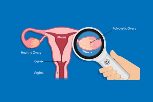 Women with PCOS likely to have attention, cognitive issues: Study