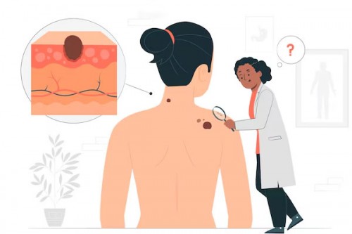 Skin cancer surges worldwide in older men in last 30 years: Study