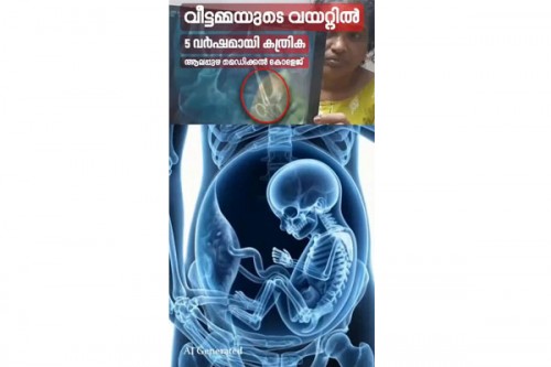 Cong leaders slam Vijayan govt over 'isolated incidents' claim in Kerala health sector