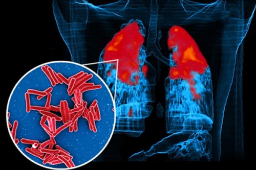 IIT Bombay study shows how TB bacteria shield themselves from antibiotics, stay alive longer