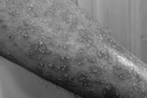 Early exposure to pet dogs may lower kids' risk of eczema: Study