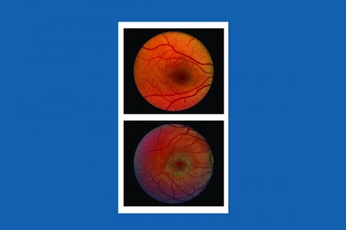 Surgical implant can slow down vision loss caused by blinding eye disease: Study