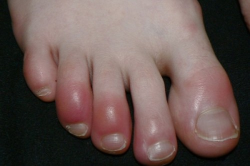 Swelling in feet could be signs of kidney trouble
