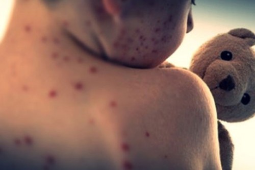Measles cases in US hit highest level in over 30 years
