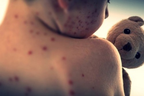 US reports over 2,000 measles cases in 2025, highest since 1992
