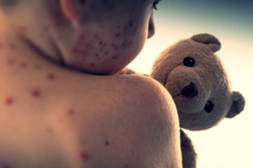 Bangladesh measles outbreak: Four more children die; toll rises to 280