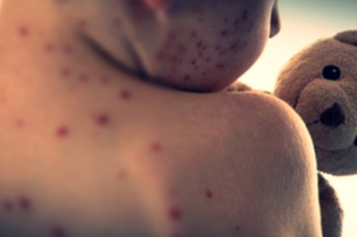 Mongolia's confirmed measles cases exceeds 10,000