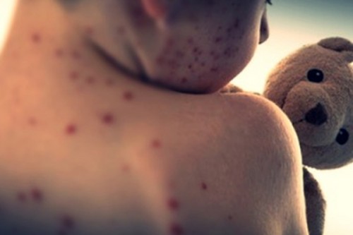 Measles death toll climbs to 10 in Mongolia