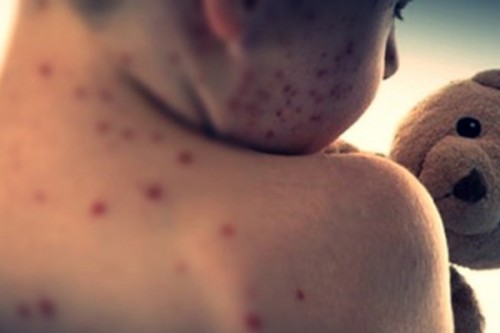 US reports record measles cases since 1992