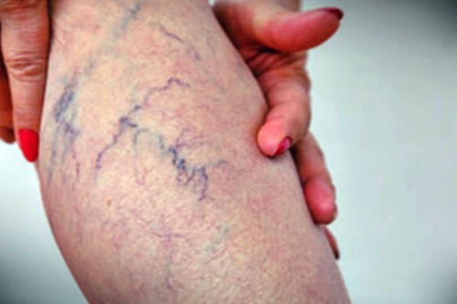 25 per cent of Indians affected by Varicose Veins, say health experts